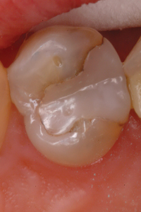 Stains and secondary decay around the defective margins.