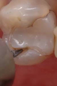 Stains and secondary decay around the defective margins are removed.