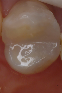 Fit SA is plaque resistant and remineralizes the surrounding tooth structure without a bonding agent barrier, thereby preventing future perimeter breakdown and staining.