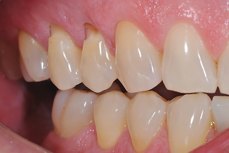 Before and after images of Cl V restorations using Fit SA (Courtesy of Dr. Jack Griffin).