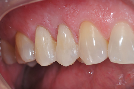 Before and after images of Cl V restorations using Fit SA (Courtesy of Dr. Jack Griffin).