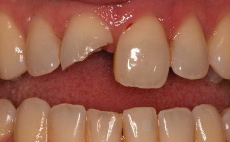 Fractured maxillary right central incisor as a result of an injury during an adult hockey league.