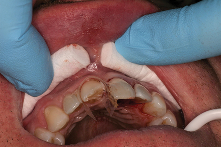 Initial isolation of the fractured tooth with a specialized clear plastic matrix.