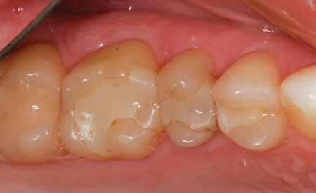 A preoperative view of 16,15, and 14 prior to preparation for indirect ceramic replacements due to marginal breakdown and recurrent decay.