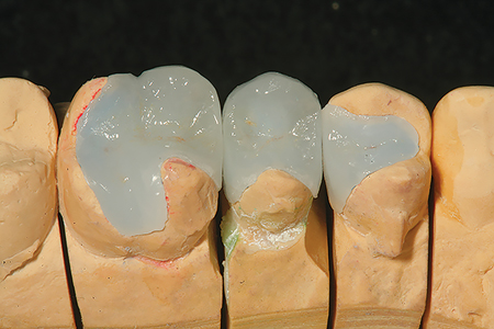 The model and master dies created from a polyvinyl siloxane impression is shown with the completed ceramic restorations in place.