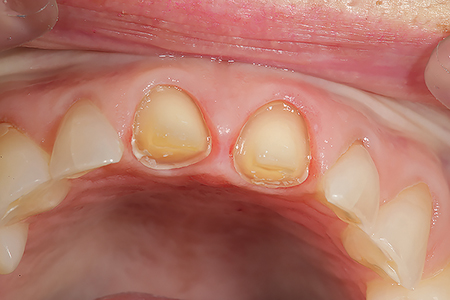 The preparations are shown at the delivery appointment after removal of the provisional restorations.