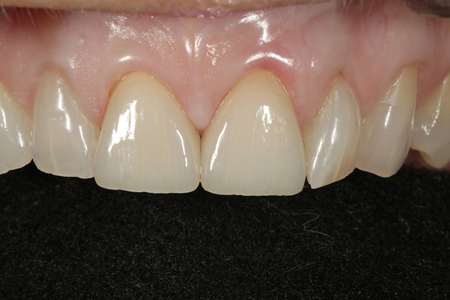 The restoration of tooth numbers 11 and 12 after cementation are shown with a “black background” to highlight characterization placed by the ceramist.