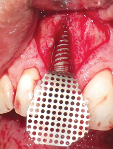 titanium mesh1 was cut to size and secured with the cover screw of the implant.