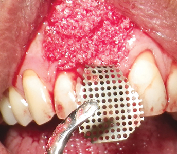 The grafting material was placed over the implant surface and surrounding exposed bone and packed down.