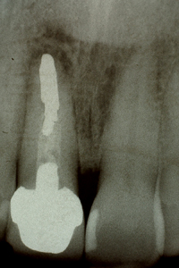 The preoperative radiograph revealed previous endodontic treatment, Post & Core and Crown restoration, and evidence of a root resection with retrograde sealing. Tooth mobility indicated a possible root fracture.
