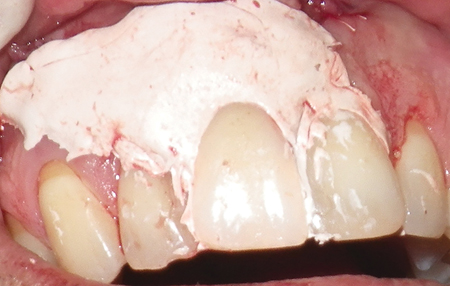 The site was covered with COE-PAK periodontal dressing (GC Canada, Brampton ON), securing the unattached denture tooth. After 5 days, the periodontal pack was removed, and the denture tooth was bonded to the adjacent teeth.