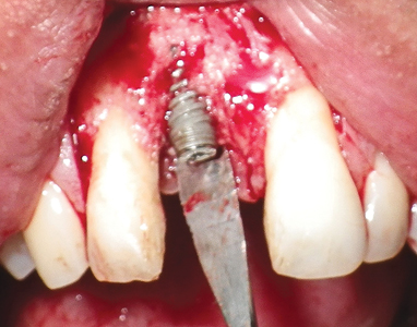 Four months after the removal of the titanium mesh, the labial tissues were reflected with a wider incision opening, gently reflecting the papillae to expose the implant. Bone had been deposited on most of the labial surface of the implant, but additional coverage was required to improve esthetics.