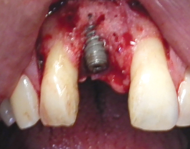 The exposed surface of the implant was gently rinsed with Peridex. A small rotating titanium brush scrubbed the implant surface and threads. Holes were drilled in the adjacent bone to stimulate bleeding in preparation for a second grafting. A,B. Gen-Os (OsteoBiol by Tecnoss, Pianezza, Italy) a porcine xenograft was placed on the exposed threads.