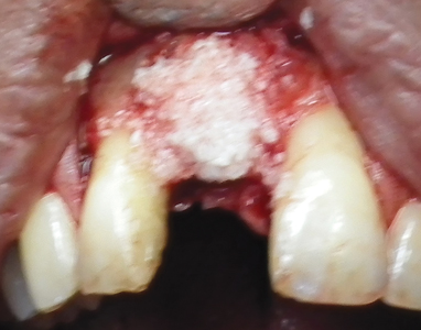 Gen-Os (OsteoBiol by Tecnoss, Pianezza, Italy) a porcine xenograft was placed on the exposed threads.