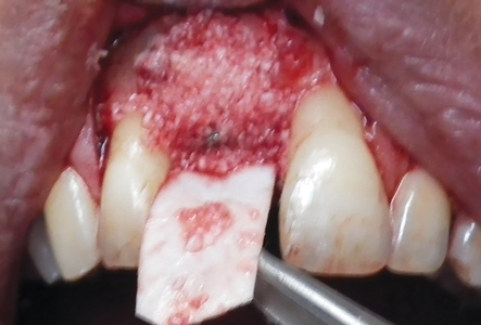 The site was then covered with an Evolution membrane (OsteoBiol by Tecnoss).