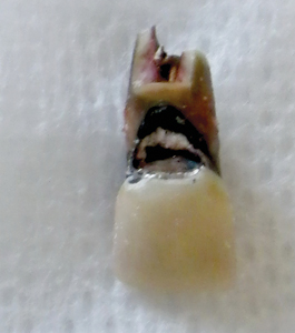 The right central was extracted under local anesthetic, but a significant portion of the root was retained in the bone.