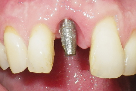 The soft tissue healed, and the abutment post was placed. The papillae on either side of the implant were well-developed, anatomically correct, and esthetic.
