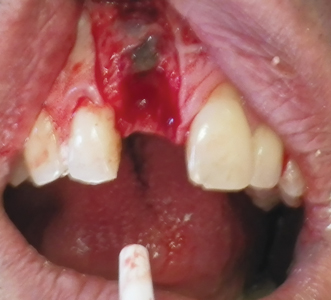 A full thickness flap revealed the remaining portion of the root.