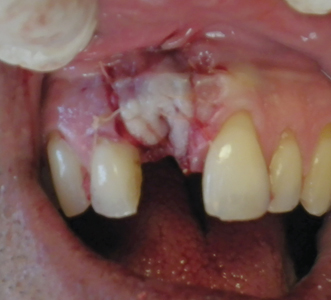 The soft tissues were approximated and sutured.