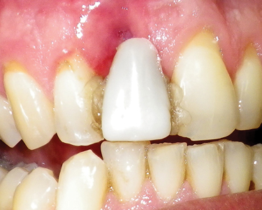 A five-week period was allowed for the site to heal, at which time a deep depression was noted in the gingival labial region.