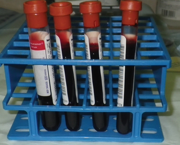 Prior to re-entering the site, four vials of blood were drawn from the patient and stored without anticoagulant.