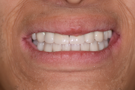 Patient smiling, post treatment.