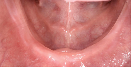 Occlusal view of mandibular arch.