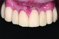 Maxillary transitional fixed partial dentures.