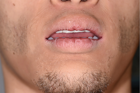 Wax try-in appointment with lips at rest.