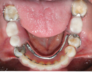 The missing teeth in the mandible were replaced with a tooth supported removable partial denture.