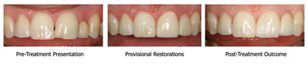  This patient was seeking a solution to replace a bonded porcelain fused to metal pontic #2.2 with poor esthetics. The inter-radicular space precludes an implant. Following a discussion about possible treatment plans, the patient elected a cantilever pontic (#21-p). Note the provisional restoration fabricated with a Direct Technique to preview the form and function anticipated with final fixed-prosthesis.