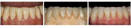 This case involved a sophisticated reconstruction of the mandibular anterior sextant with porcelain veneers. Note the creation of minor tooth rotations and incised irregularities within the provisional restorations. Mandibular incisors are particularly challenging to restore with porcelain veneers primarily due to their small dimensions and limited restorative space when preparations must remain conservative on vital teeth.