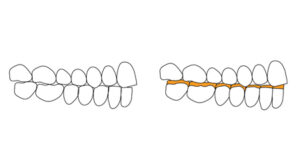  In case of localized anterior dental wear and lack of prosthetic space, the VDO needs to be increased and one of the 2 arches restored