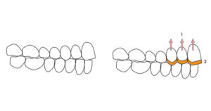 Another option when treating localized anterior dental wear and lack of prosthetic space, is to orthodontically intrude and restore only the maxillary teeth. The posterior dentition will not require any treatment. 