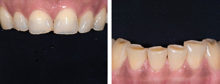 Case of anterior dental wear treated increasing VDO and restoring the whole maxillary arch and the incisal edge of the mandibular anterior teeth.