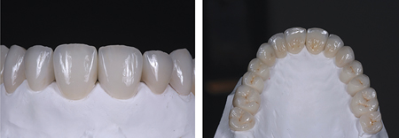Case of anterior dental wear treated increasing VDO and restoring the whole maxillary arch and the incisal edge of the mandibular anterior teeth.