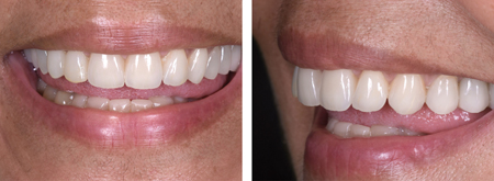 Case of anterior dental wear treated increasing VDO and restoring the whole maxillary arch and the incisal edge of the mandibular anterior teeth.