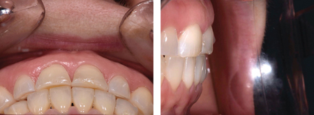 Due to dental wear supra-eruption of the teeth has occurred and no prosthetic space is available in the anterior region.
