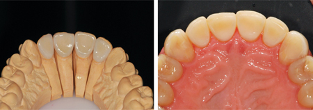 . Palatal feldspathic veneers fabricated and bonded to restore the worn teeth. 2