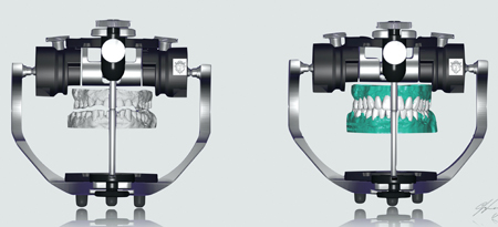 The digital models were “mounted” on a virtual articulator and a diagnostic wax-up done.