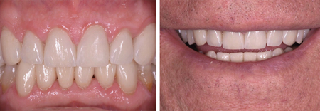 Other than function, a good aesthetic result was achieved with the restorations. The patient was very pleased