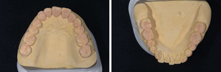 Diagnostic wax-up done at an increased VDO. 2 clear PVS matrices were fabricated for the “injection moulding” technique.