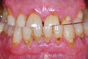 Advanced attrition of teeth. In advanced stages, pulp chamber/root canal system might be visible.