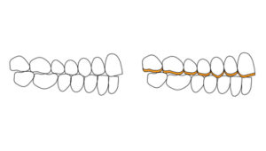 In case of localized anterior dental wear and lack of prosthetic space, the VDO needs to be increased and one of the 2 arches restored