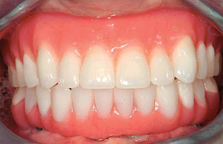 Treatment planning with dental implants – Mandible.