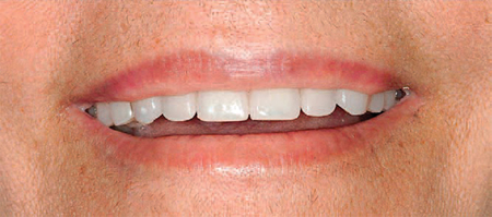 Treatment planning with dental implants – Mandible.