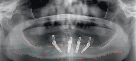 Treatment planning with dental implants - Mandible (continued).