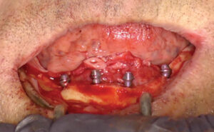 Surgical phase – Mandible.