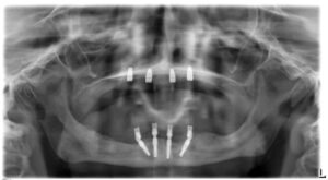 Completion of surgery and delivery of a temporary prosthesis for mandible and maxilla.