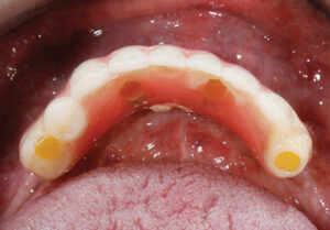 Completion of surgery and delivery of a temporary prosthesis for mandible and maxilla.